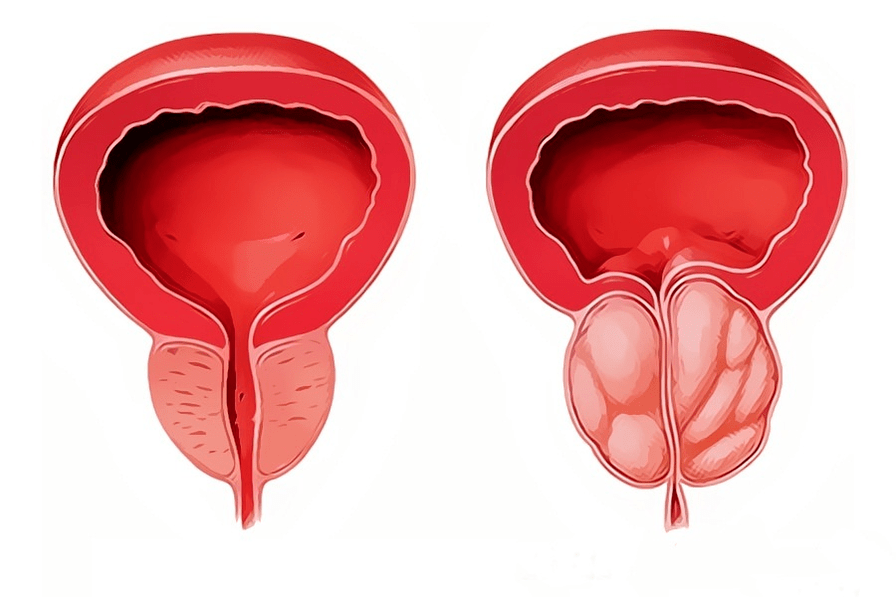an inflamed and healthy prostate