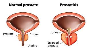 the treatment of prostatitis acute