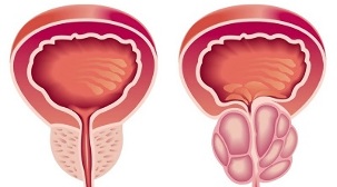reasons for the development of prostatitis and prostate adenoma
